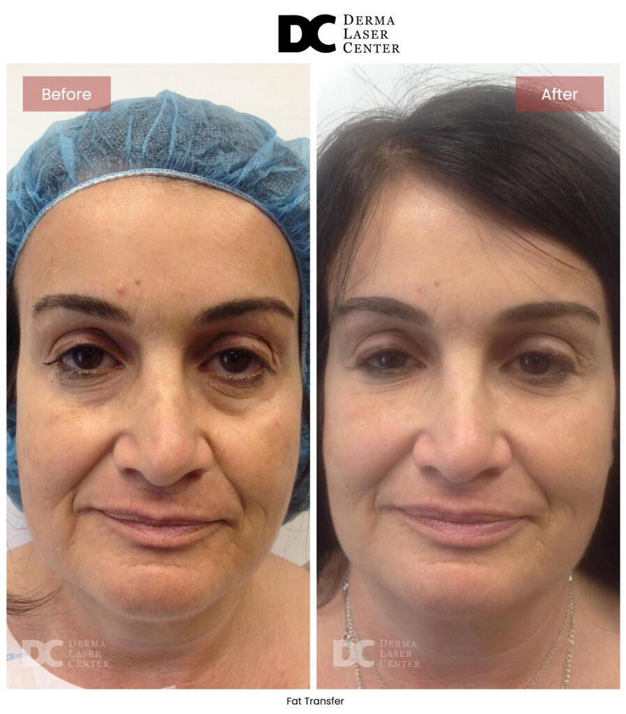 B&A Fat Transfer Image 11 V1