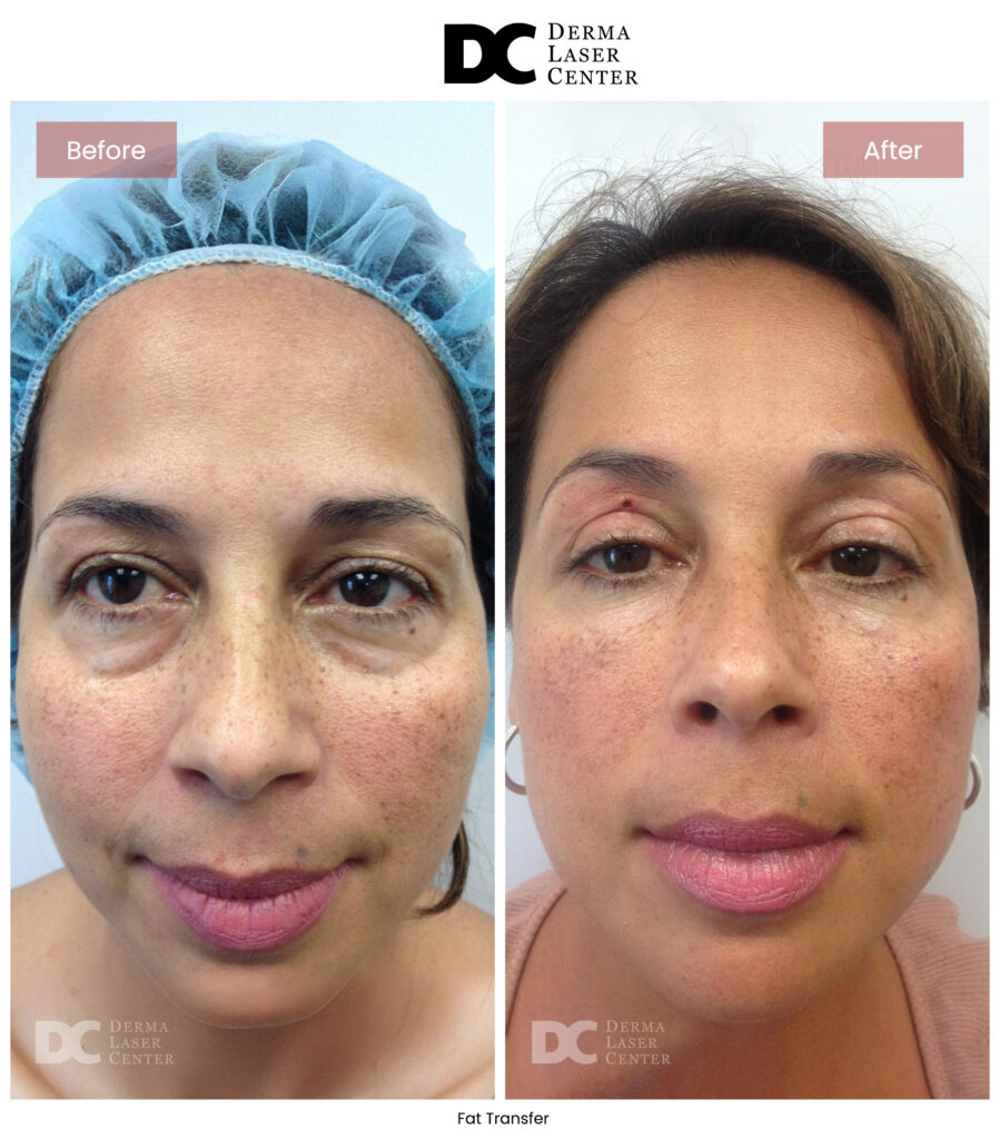 B&A Fat Transfer Image 13 V1