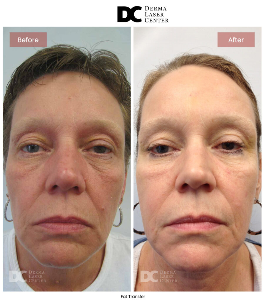 B&A Fat Transfer Image 14 V1