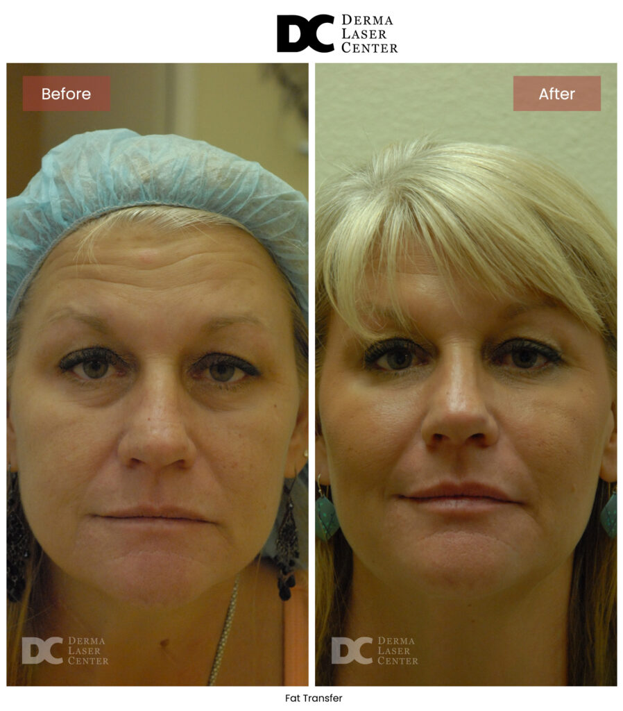 B&A Fat Transfer Image 17 V1