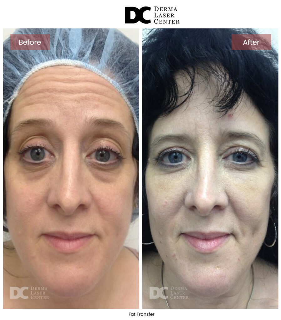 B&A Fat Transfer Image 20 V1