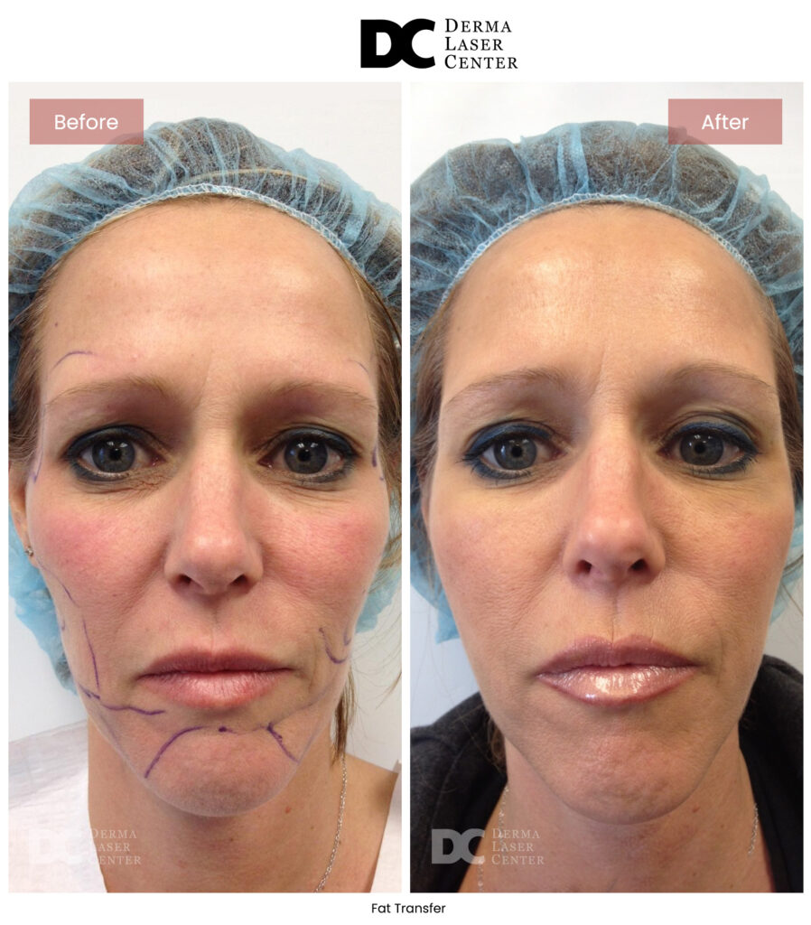 B&A Fat Transfer Image 21 V1