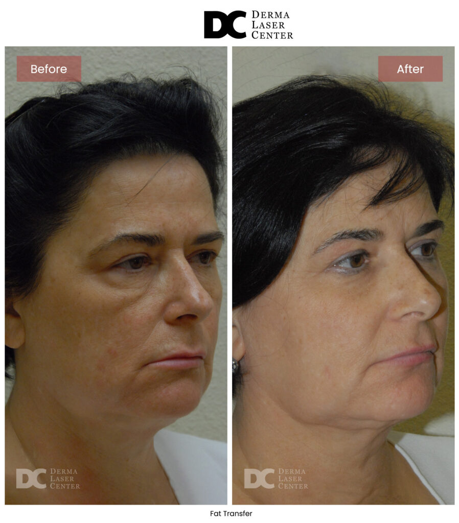 B&A Fat Transfer Image 22 V1
