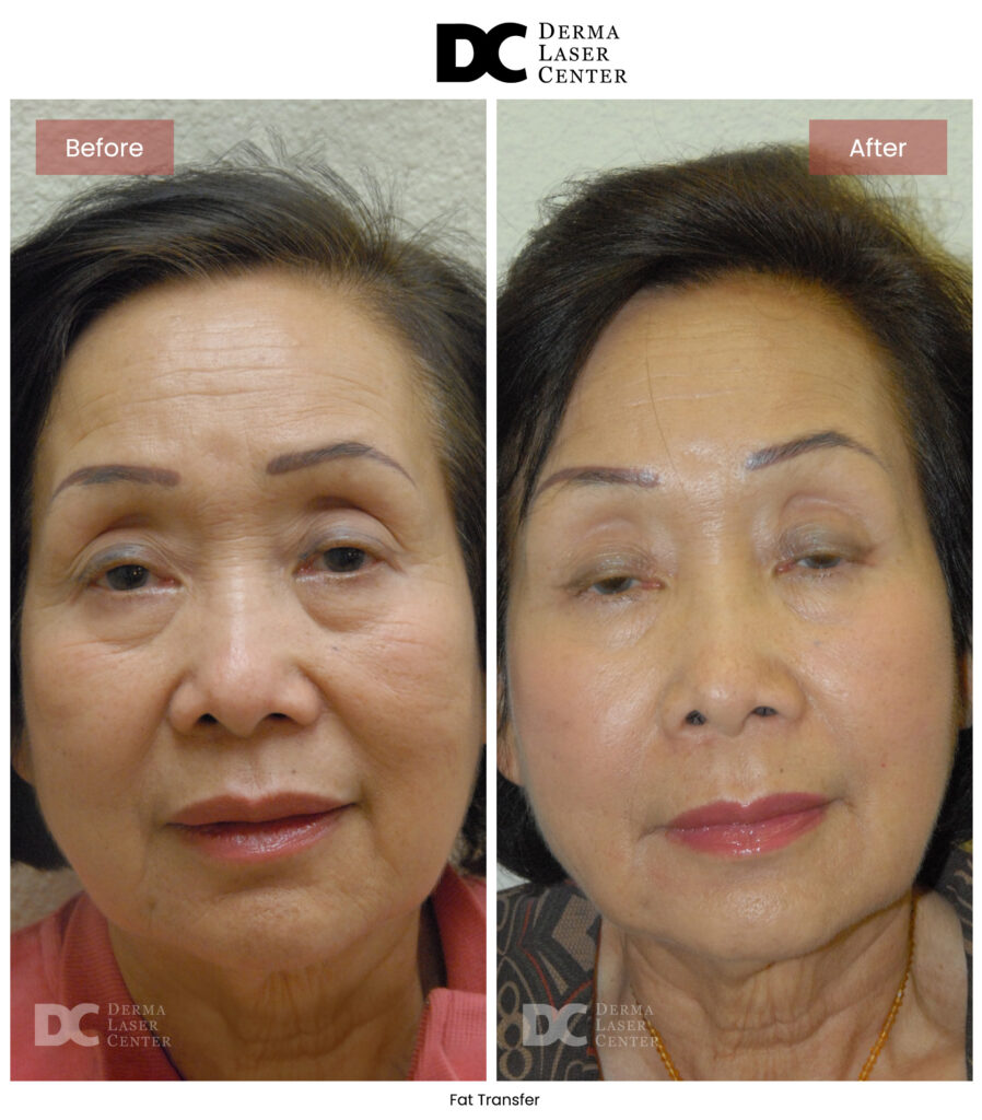 B&A Fat Transfer Image 24 V1