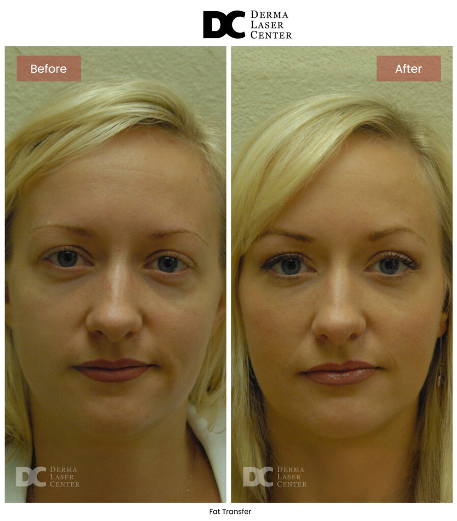 B&A Fat Transfer Image 25 V1
