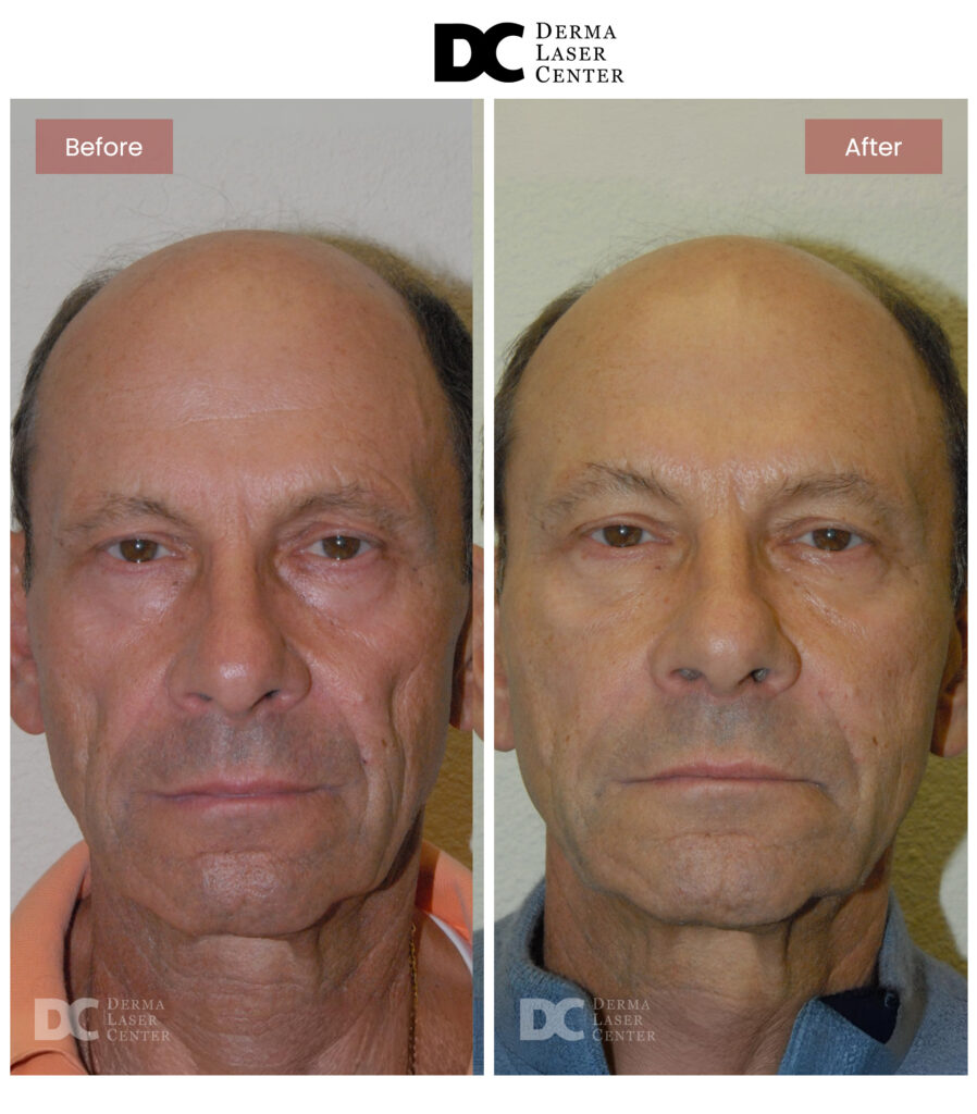 B&A Fat Transfer Image 26 V1
