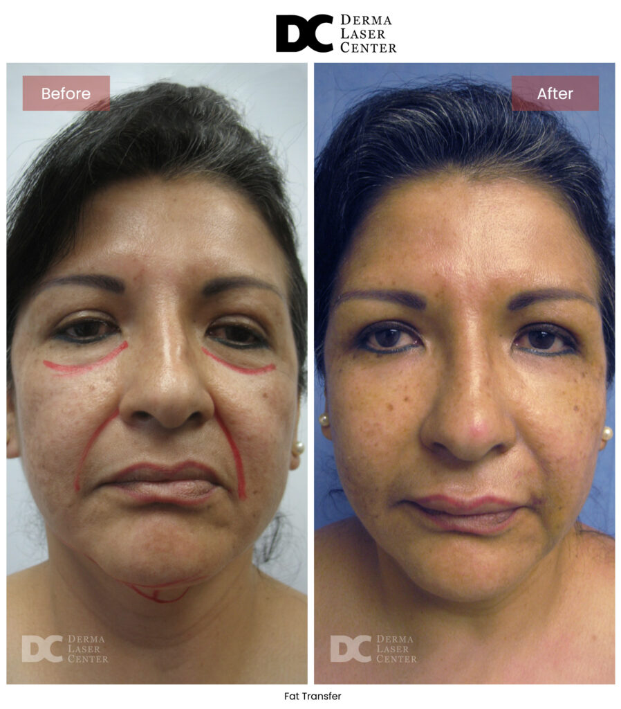 B&A Fat Transfer Image 28 V1