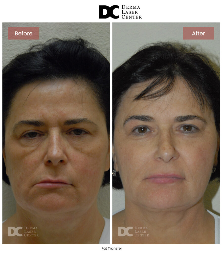B&A Fat Transfer Image 30 V1