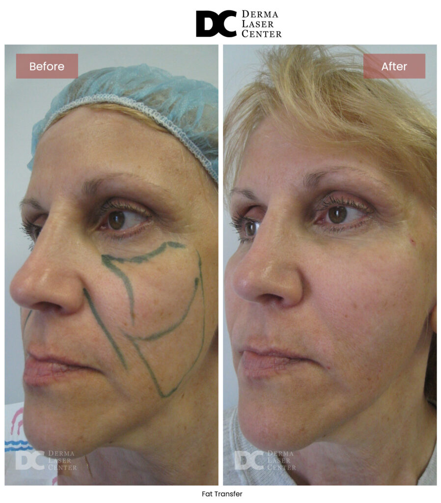 B&A Fat Transfer Image 31 V1