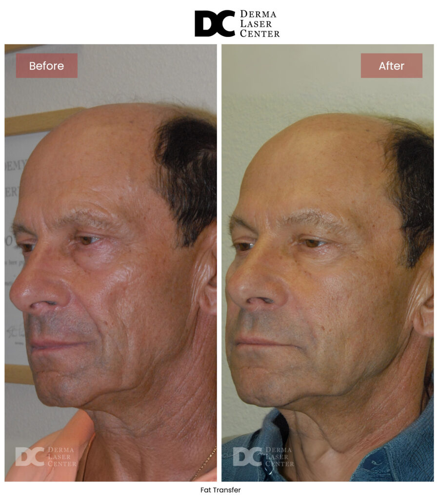 B&A Fat Transfer Image 33 V1