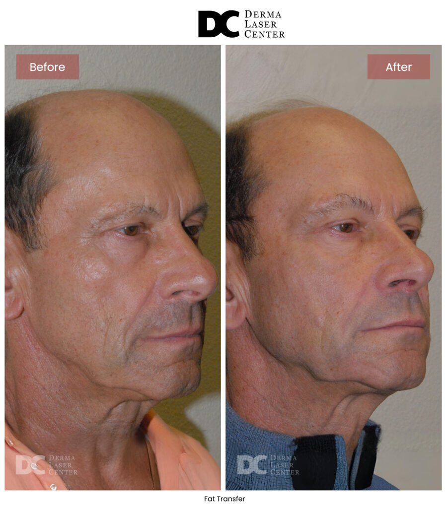 B&A Fat Transfer Image 34 V1