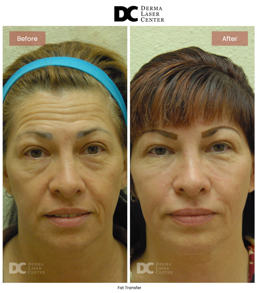 B&A Fat Transfer Image 35 V1