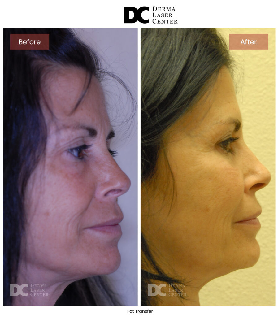 B&A Fat Transfer Image 36 V1
