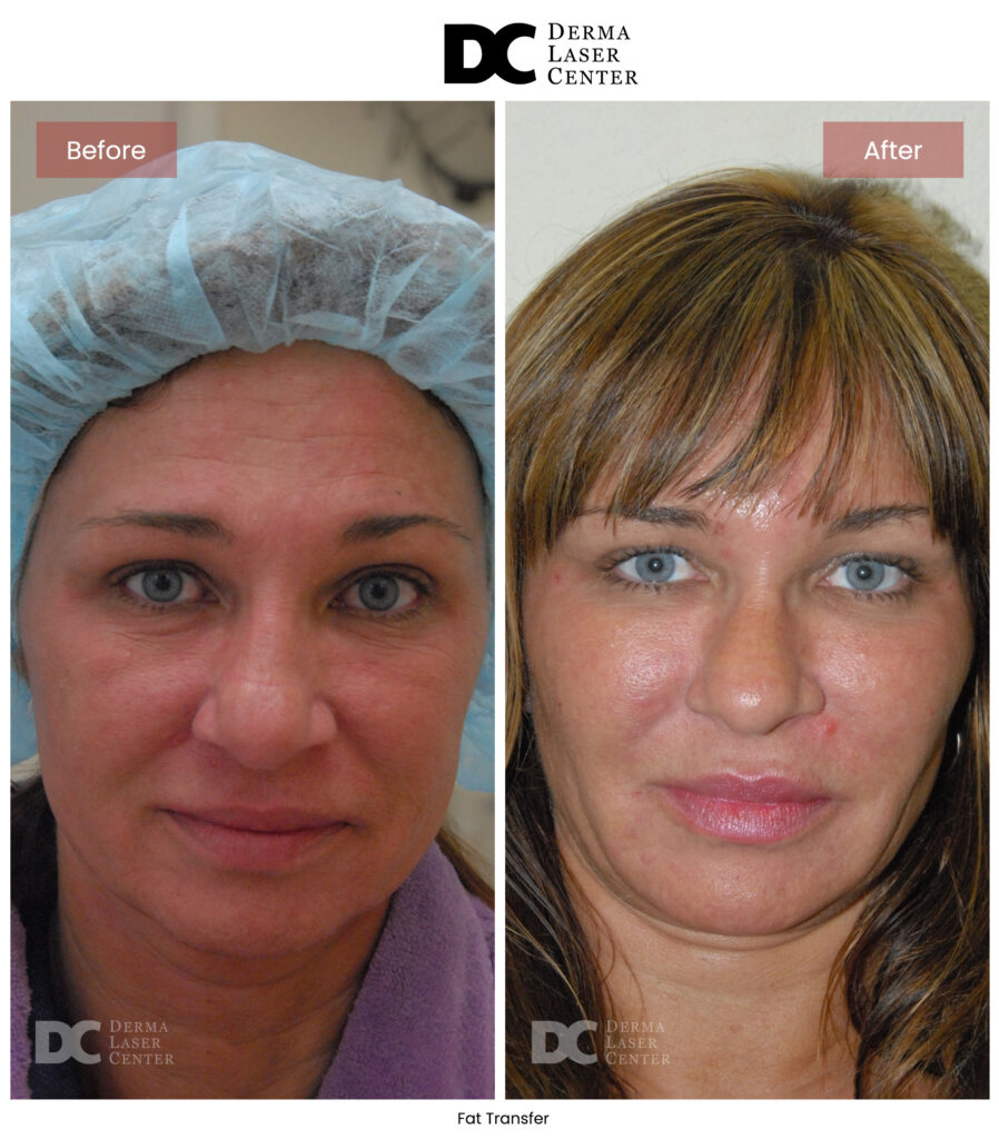 B&A Fat Transfer Image 37 V1