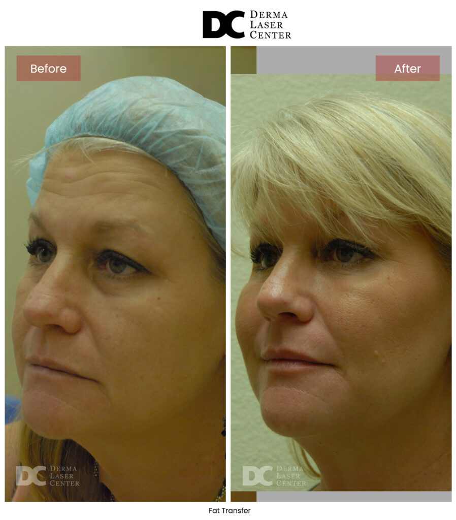 B&A Fat Transfer Image 38 V1