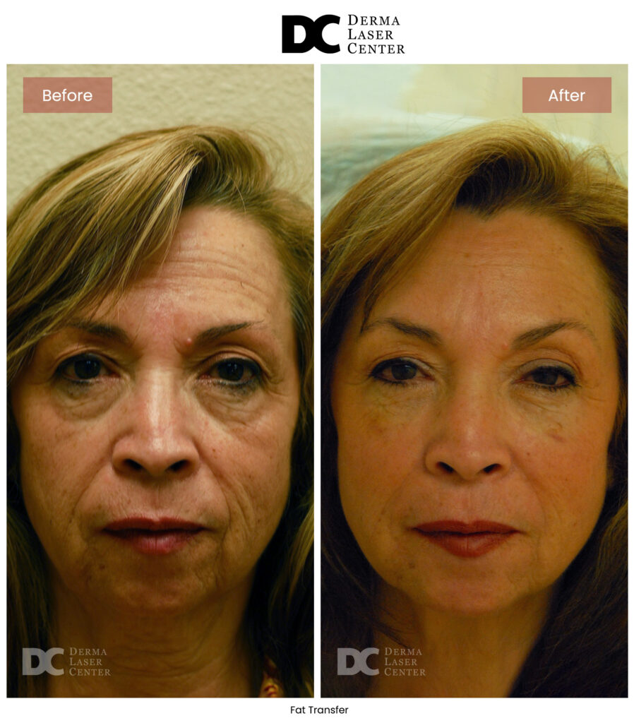 B&A Fat Transfer Image 39 V1