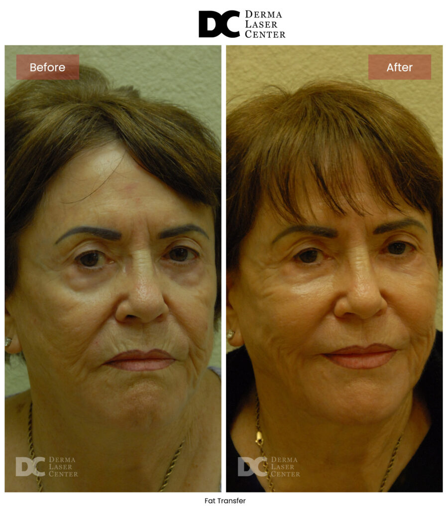 B&A Fat Transfer Image 40 V1