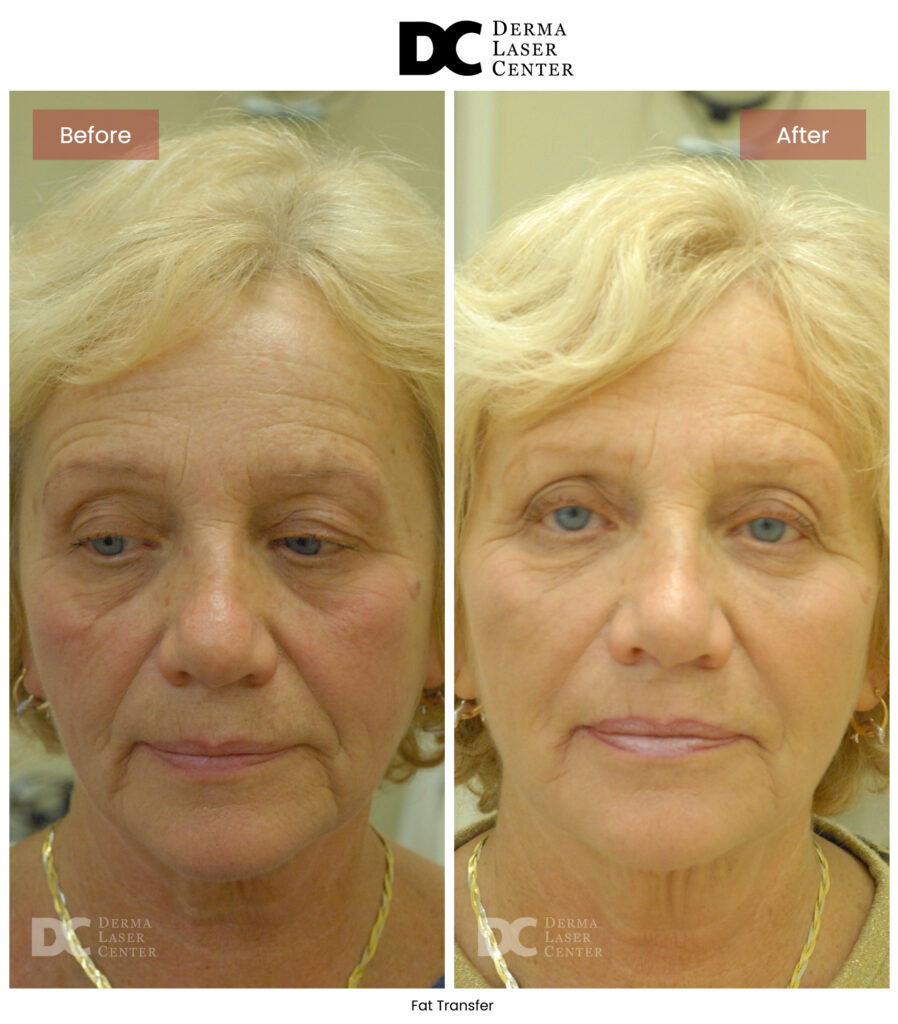 B&A Fat Transfer Image 44 V1