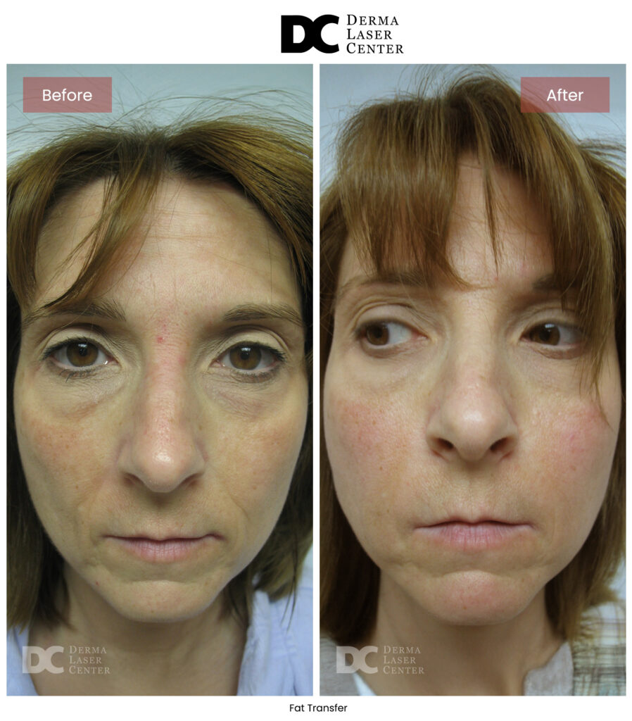 B&A Fat Transfer Image 48 V1