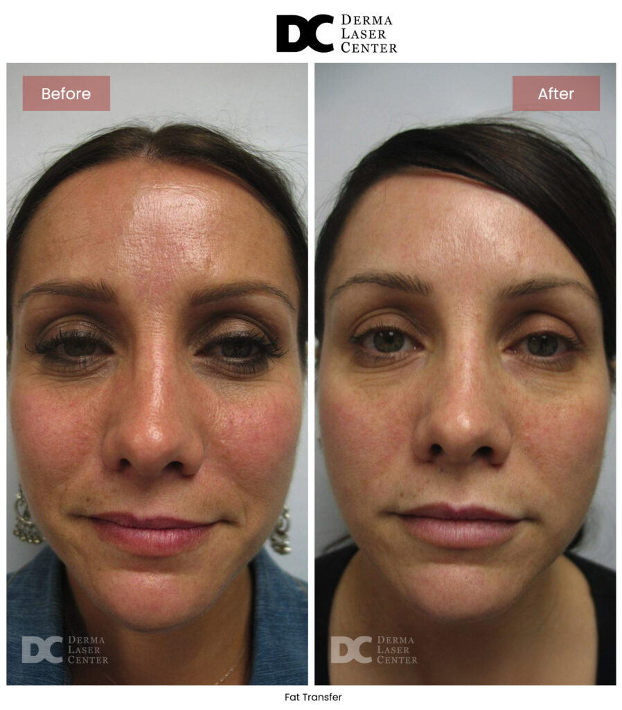 B&A Fat Transfer Image 52 V1