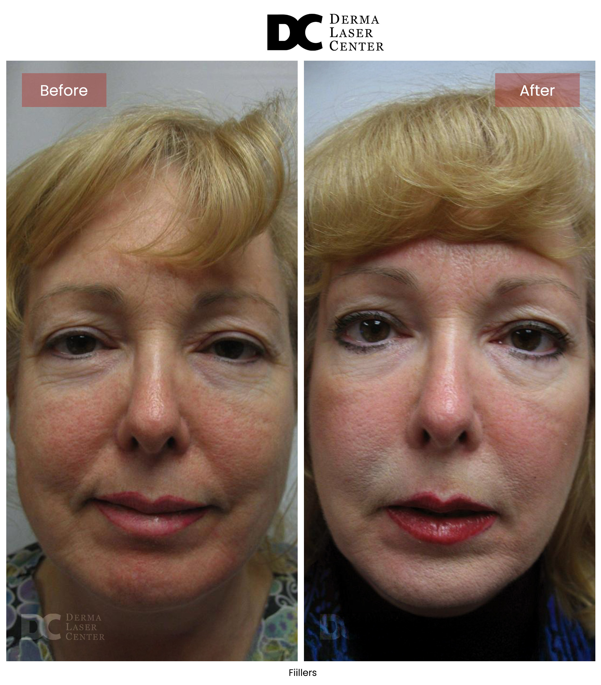 B&A Fiillers Image 02 V1