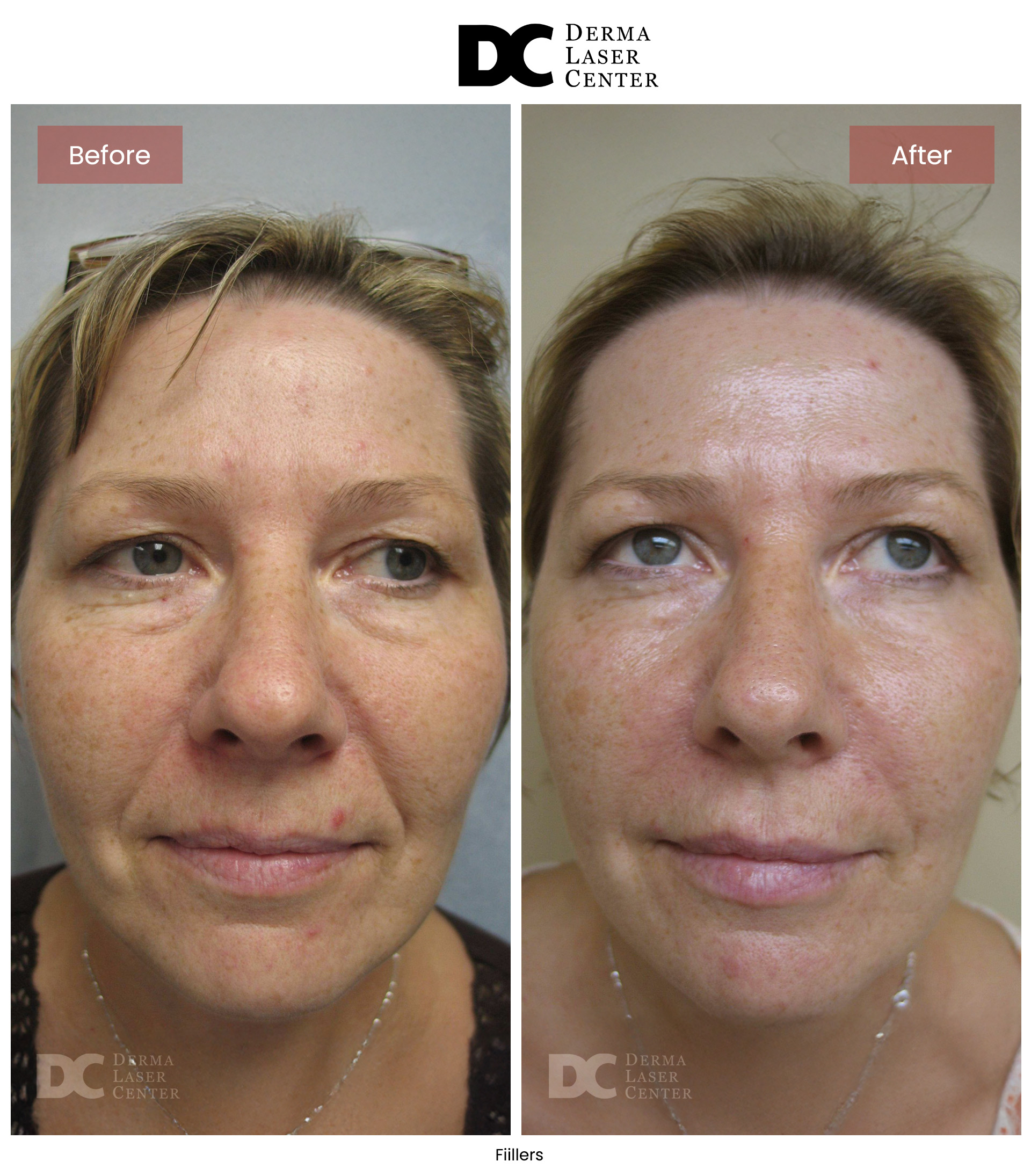 B&A Fiillers Image 03 V1