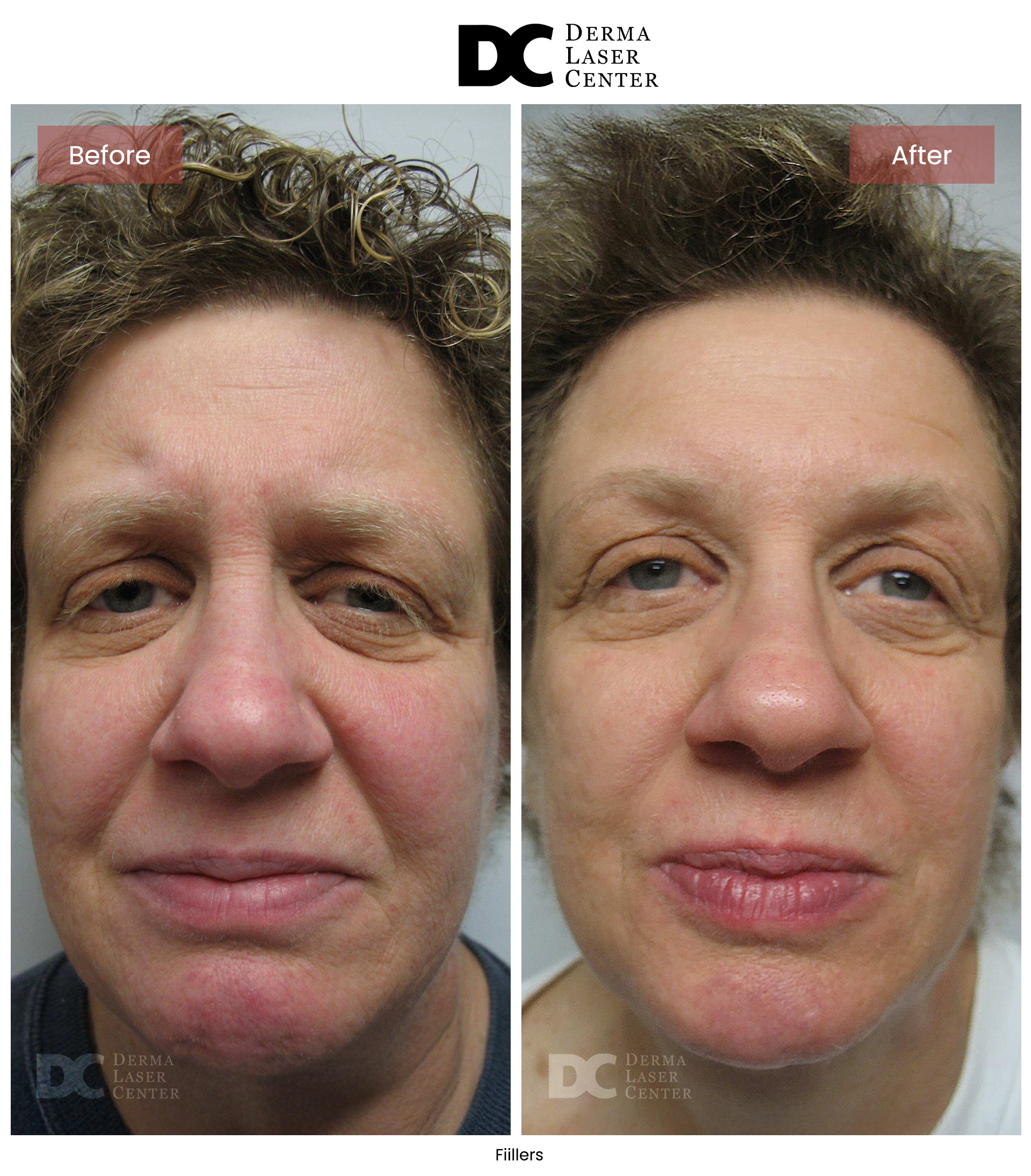 B&A Fiillers Image 04 V1