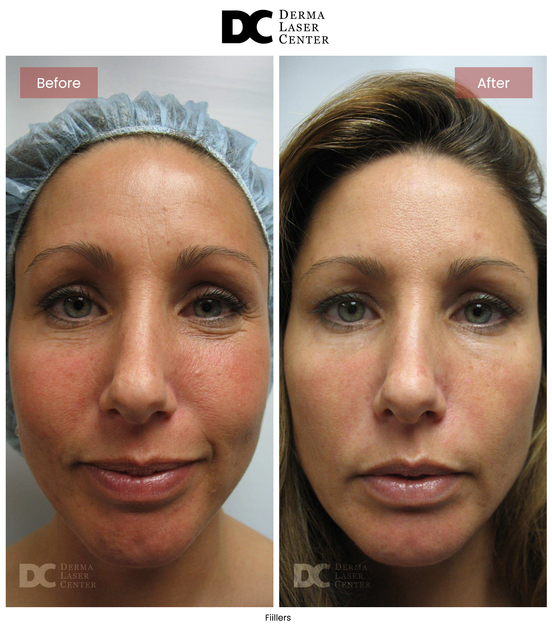 B&A Fiillers Image 06 V1