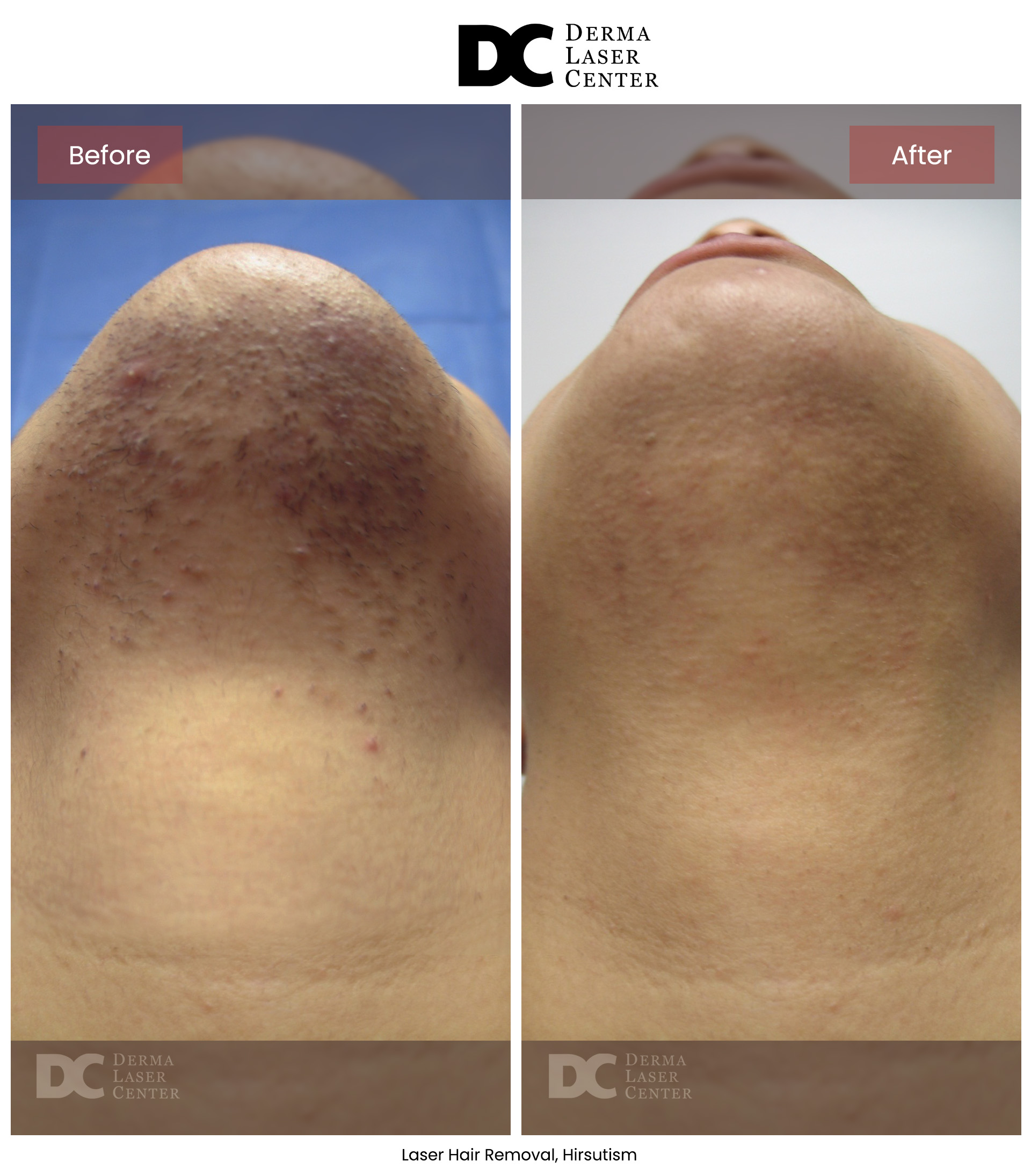 B&A Hair Removal Image 01 V1