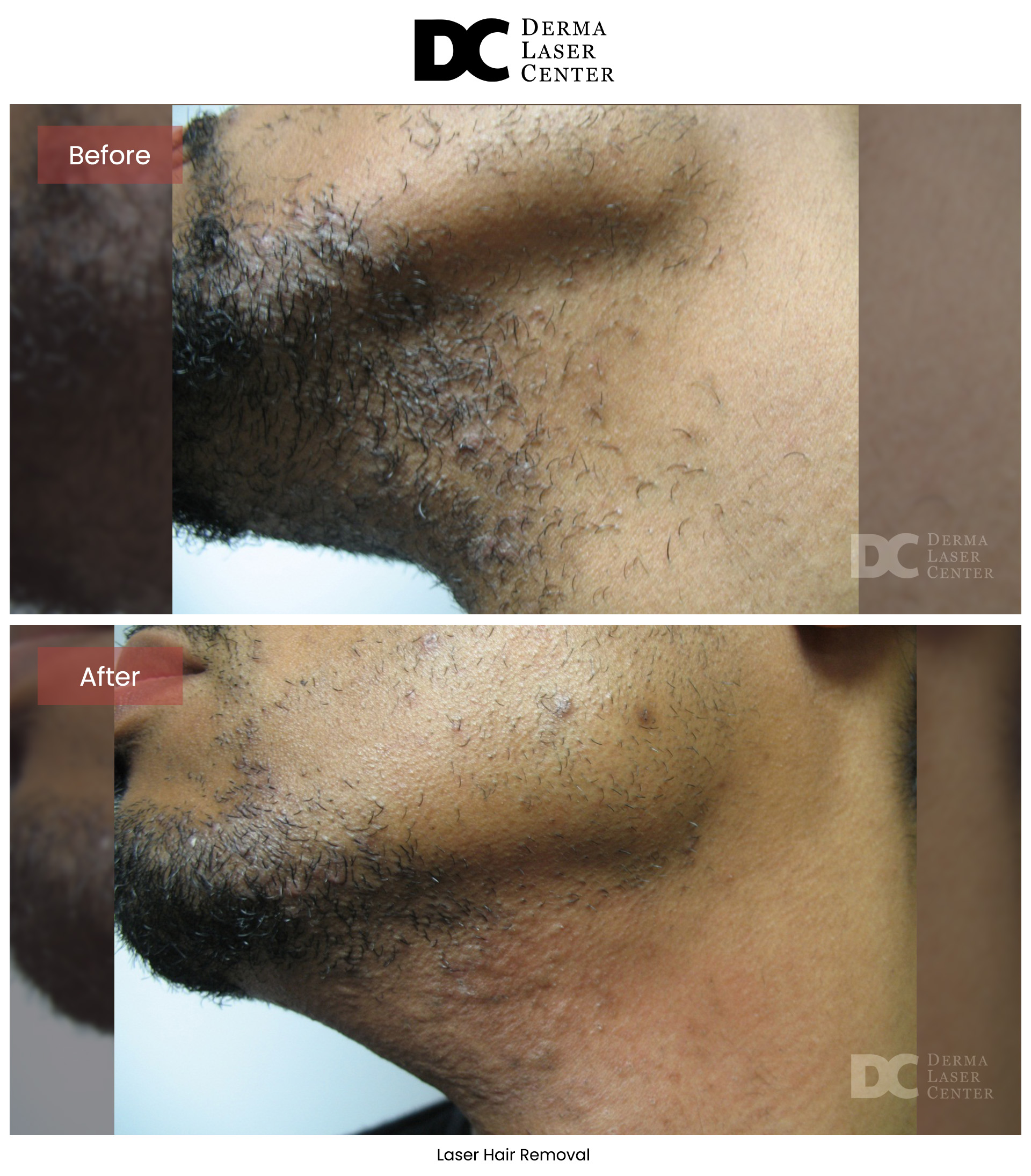 B&A Hair Removal Image 02 V1