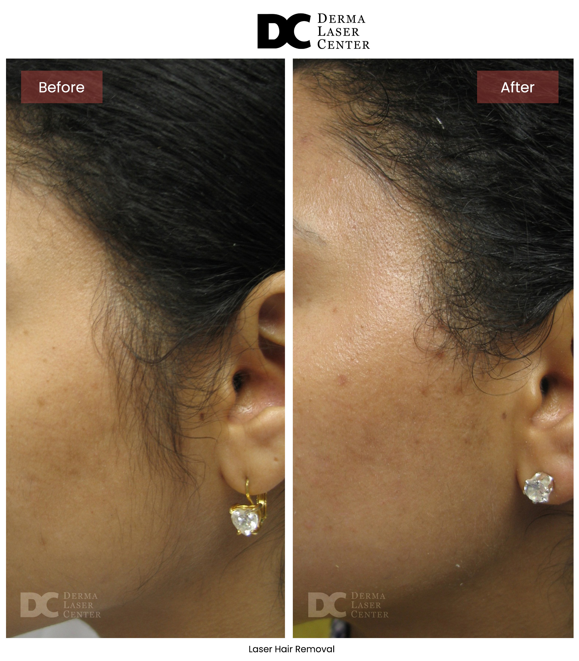 B&A Laser Image 02 V1