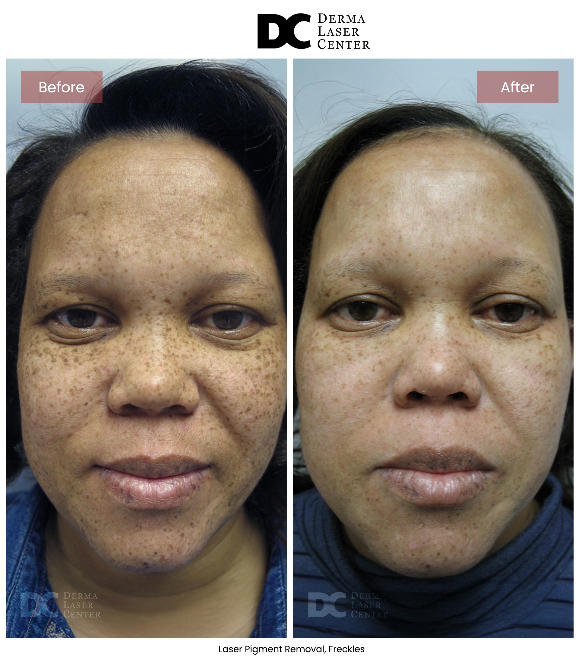 B&A Laser Image 03 V1