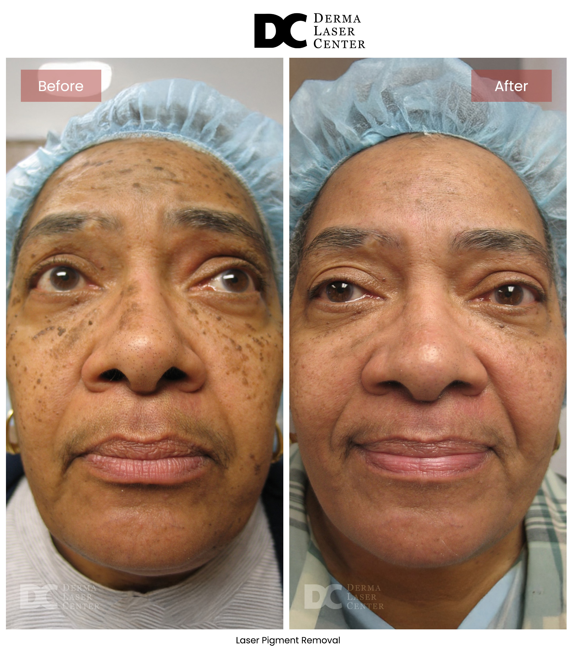 B&A Laser Image 12 V1