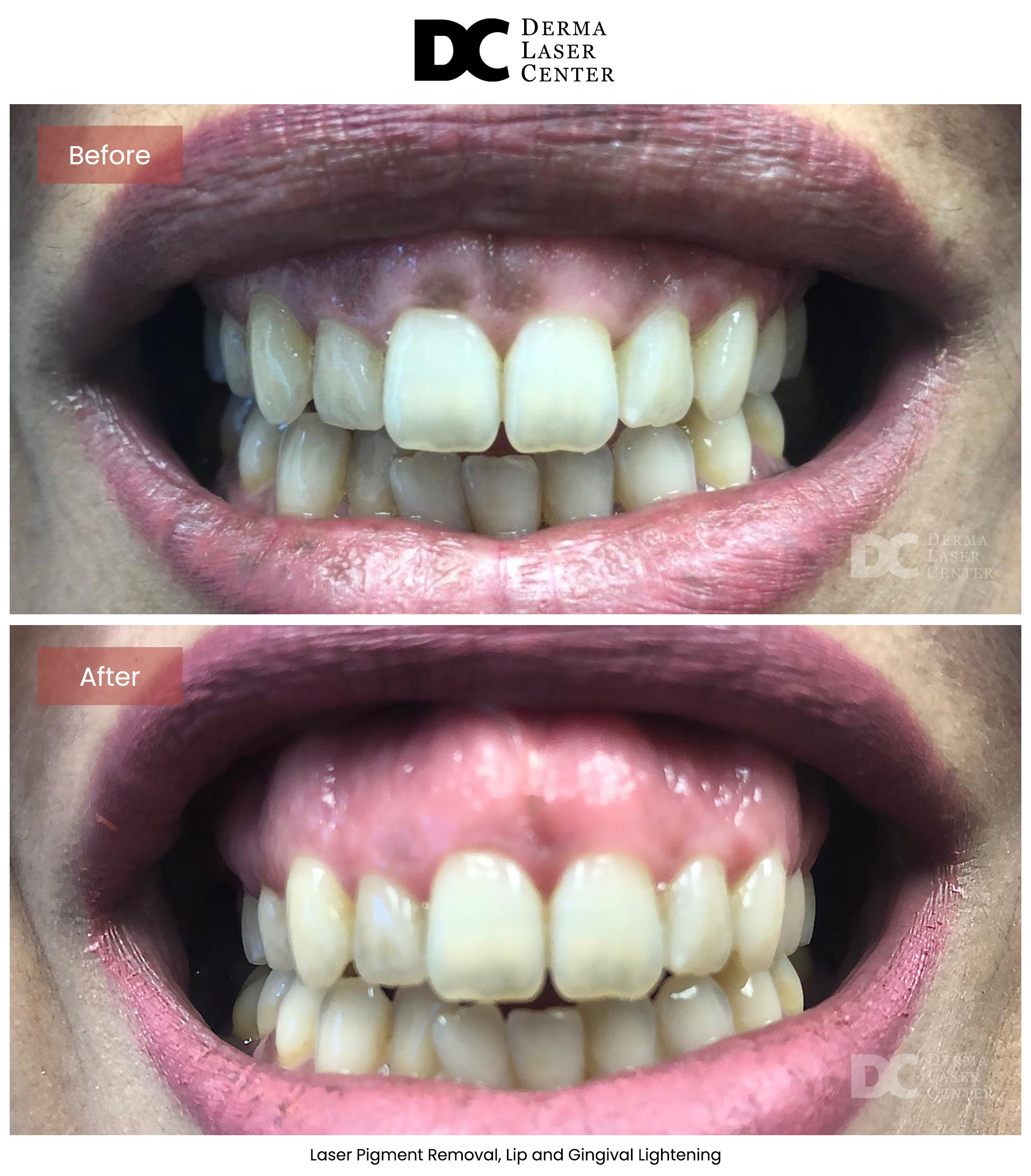 B&A Laser Image 15 V1