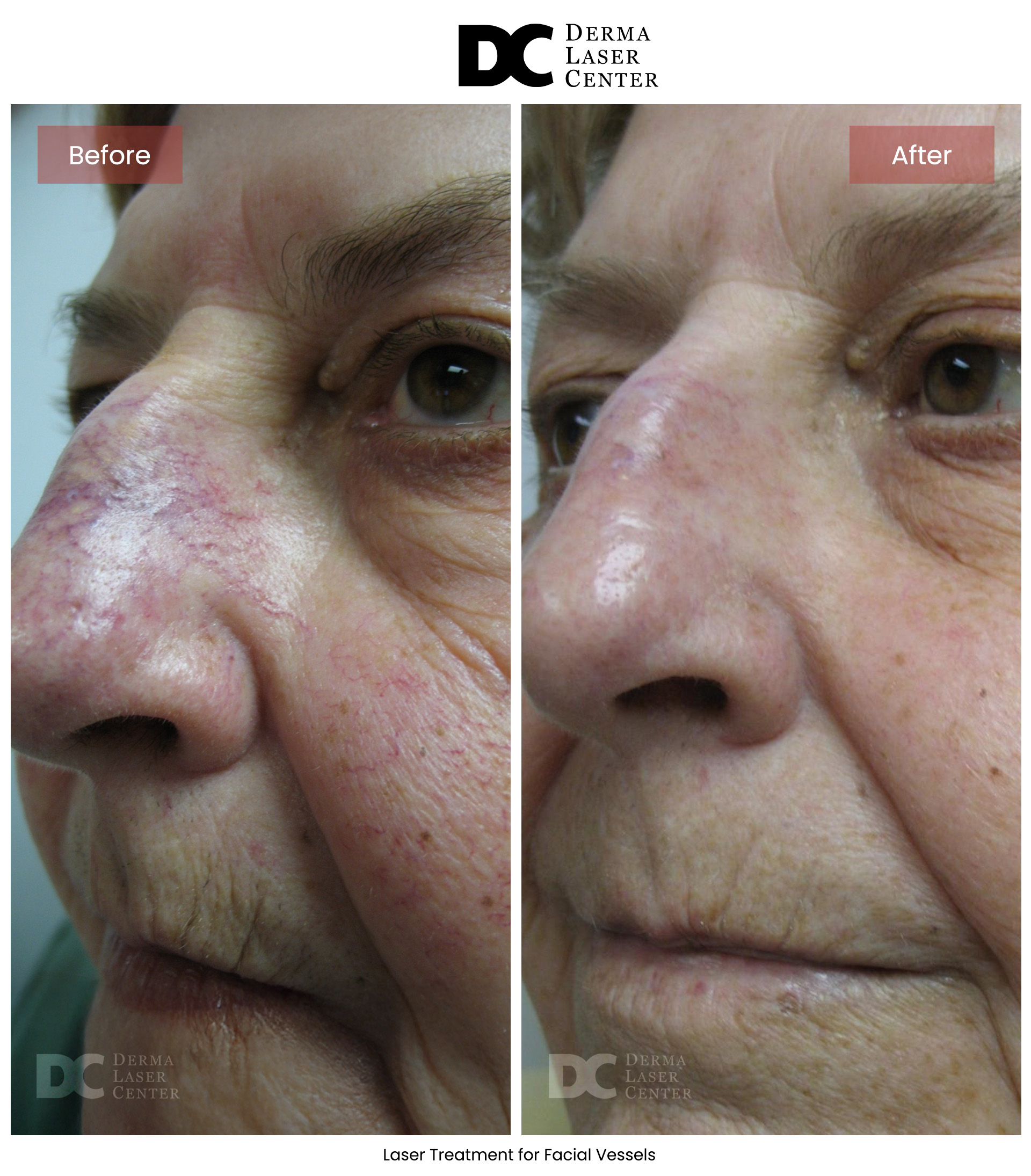 B&A Laser Image 16 V1