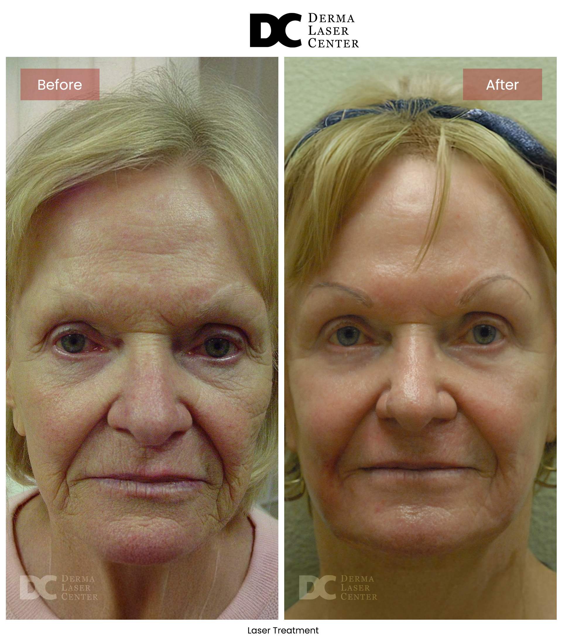 B&A Laser Image 21 V1