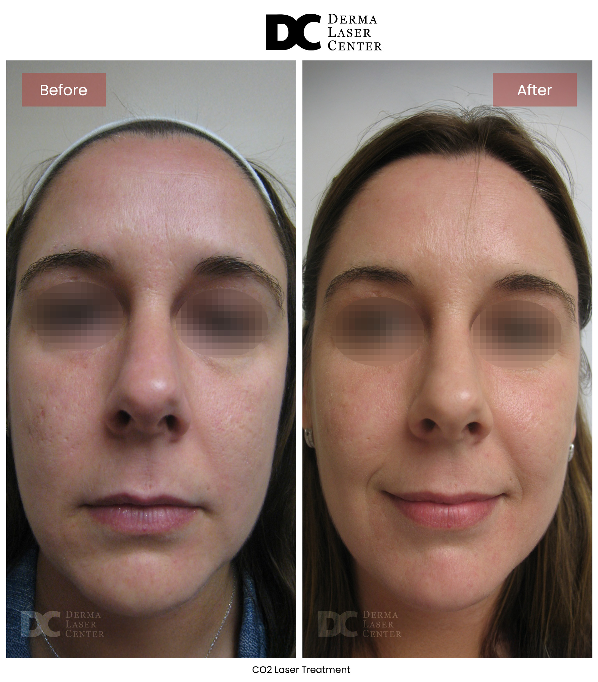 B&A Laser Image 24 V1