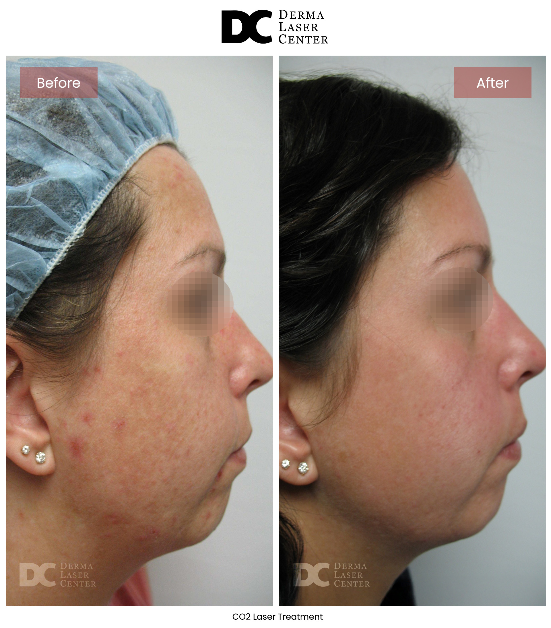 B&A Laser Image 25 V1