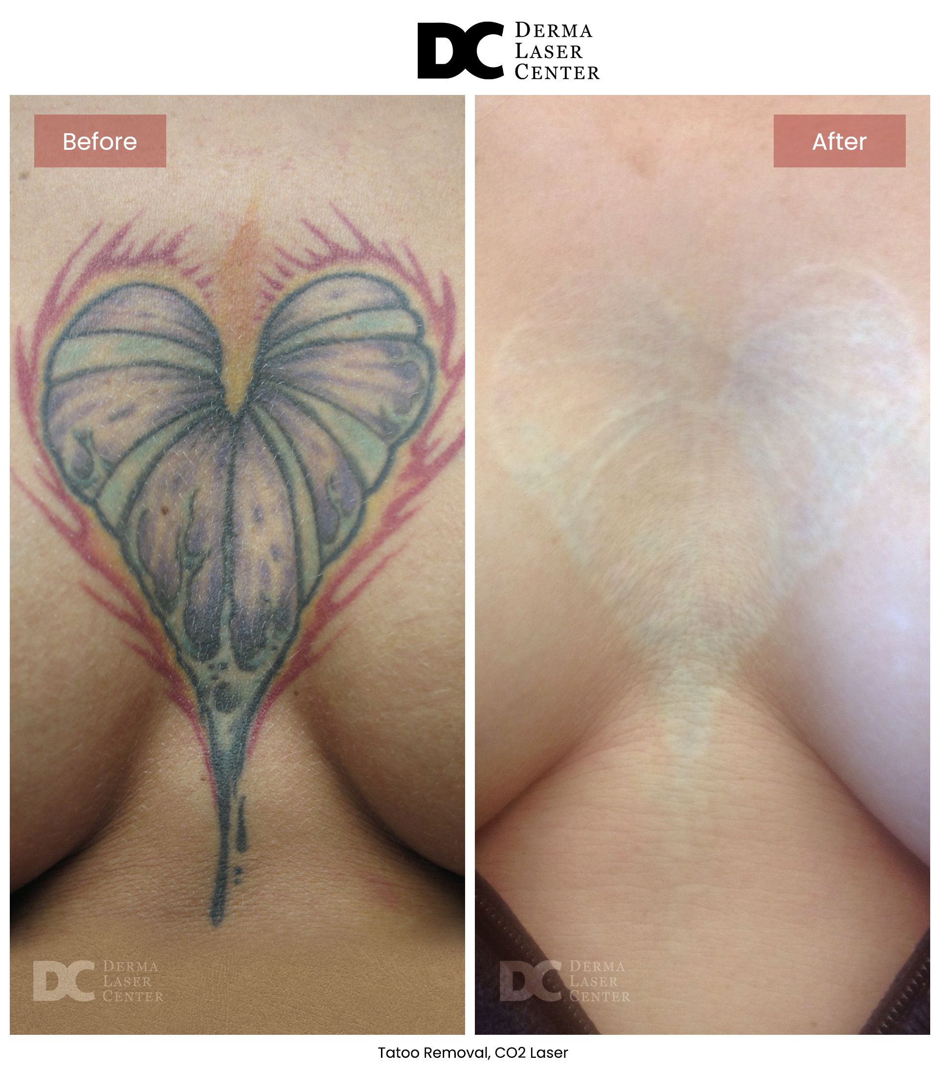 B&A Laser Image 30 V1