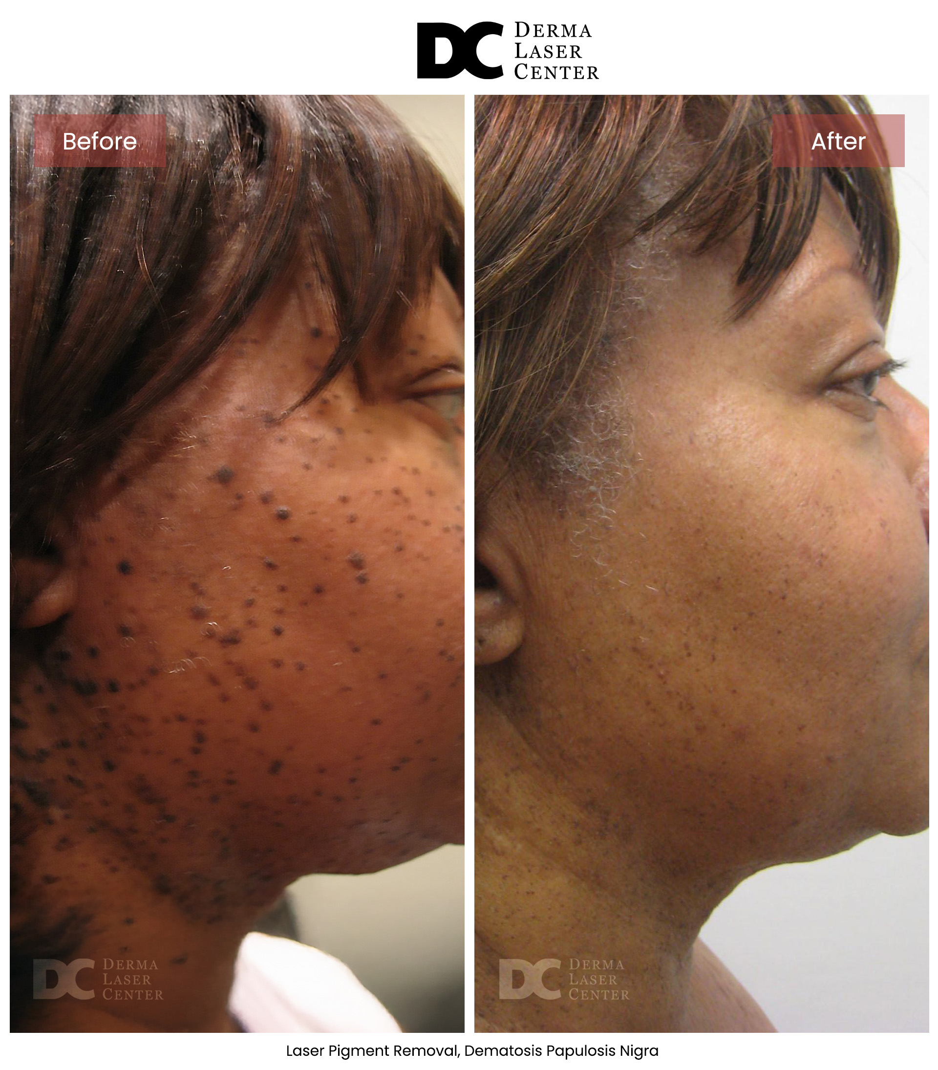 B&A Laser Image 32 V1