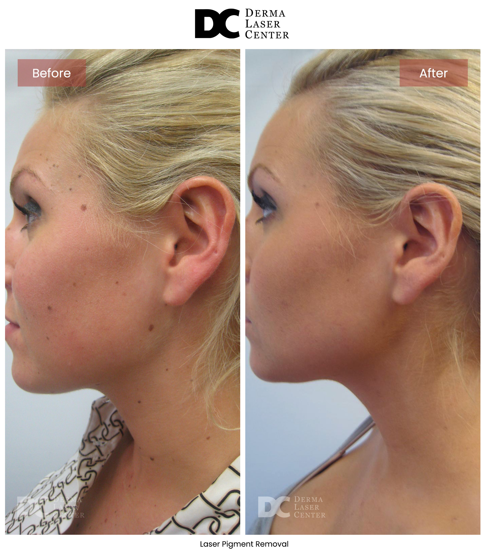 B&A Laser Image 7 V1