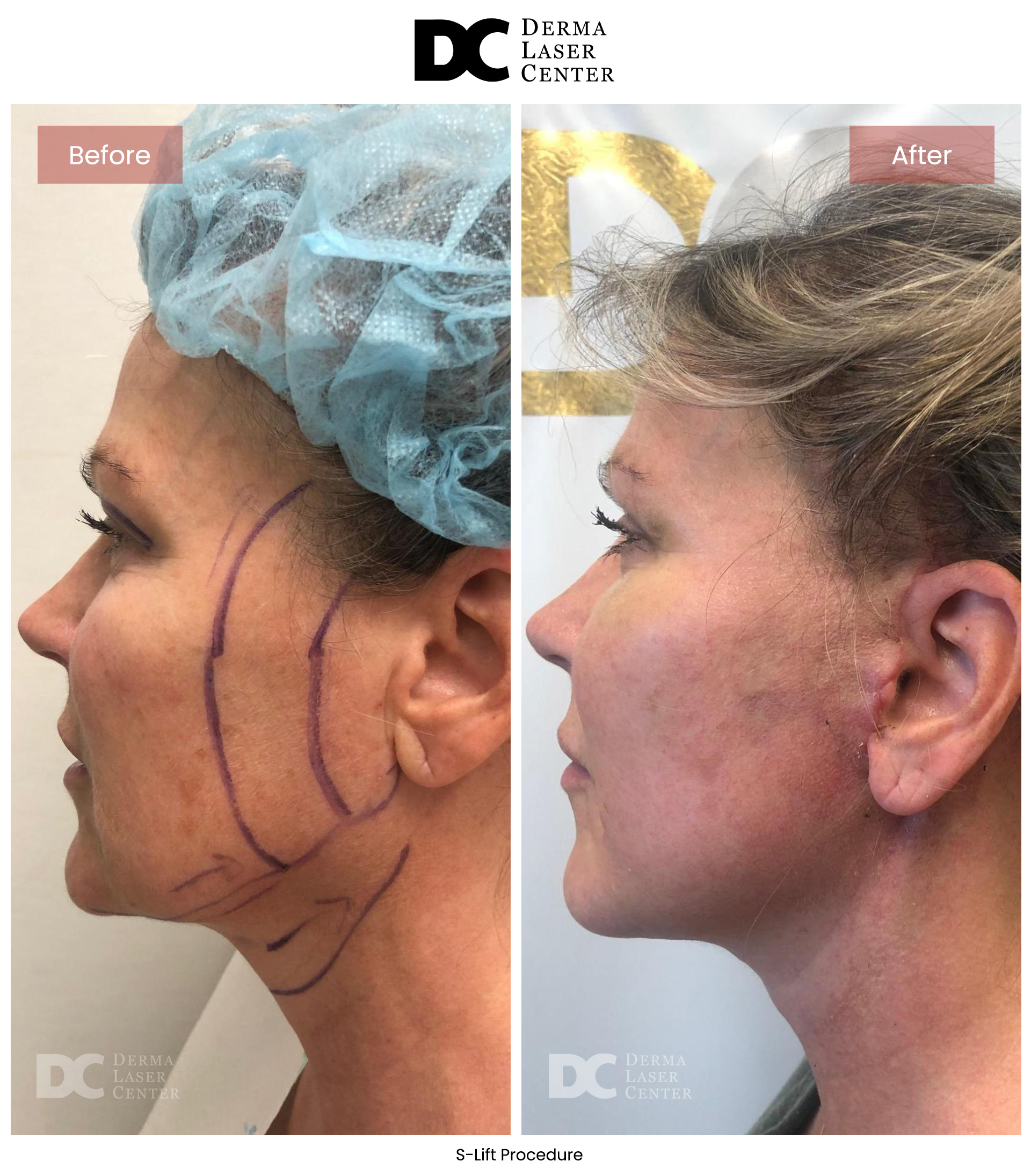 B&A S Lift Image 05 V1