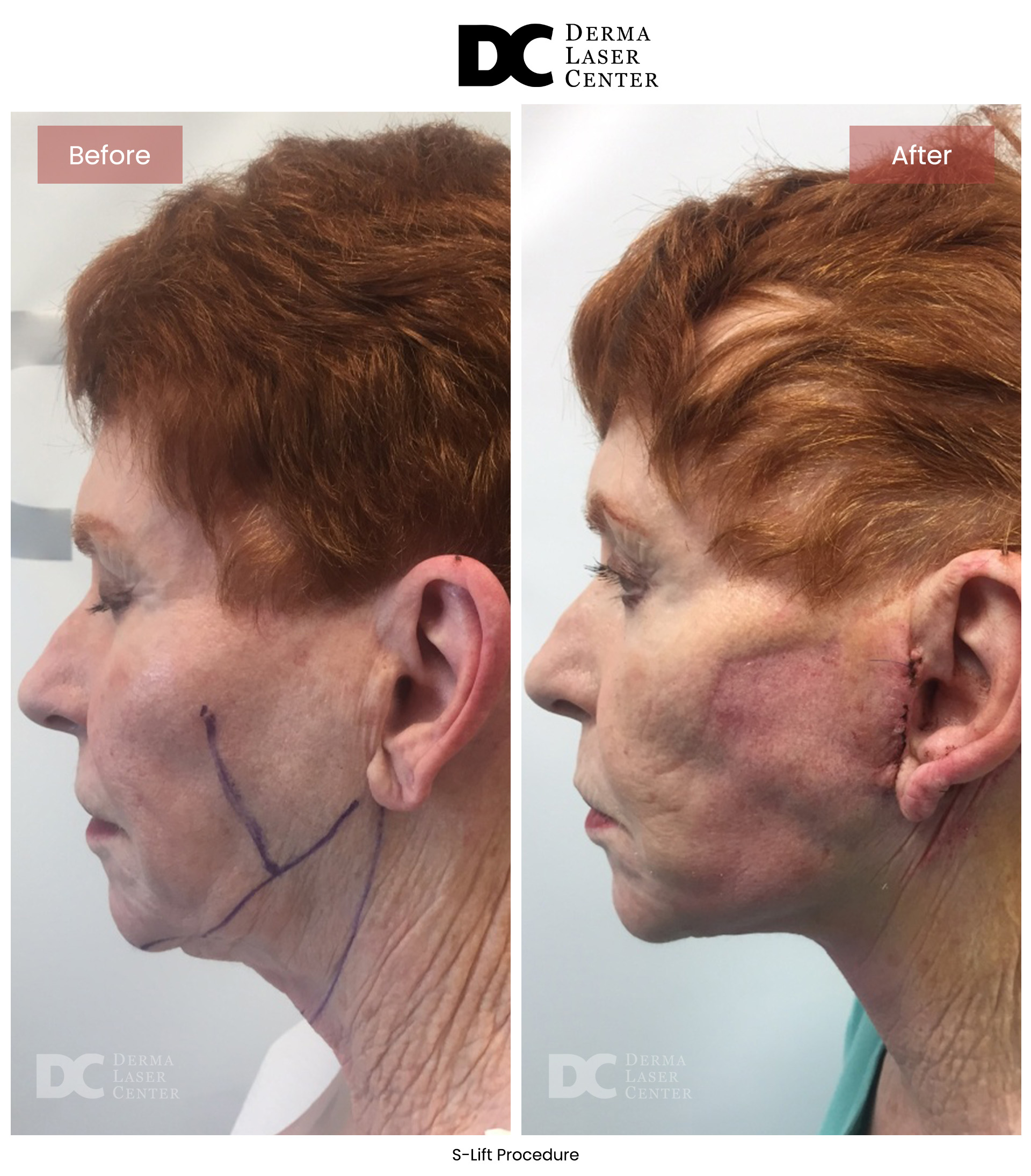B&A S Lift Image 07 V1