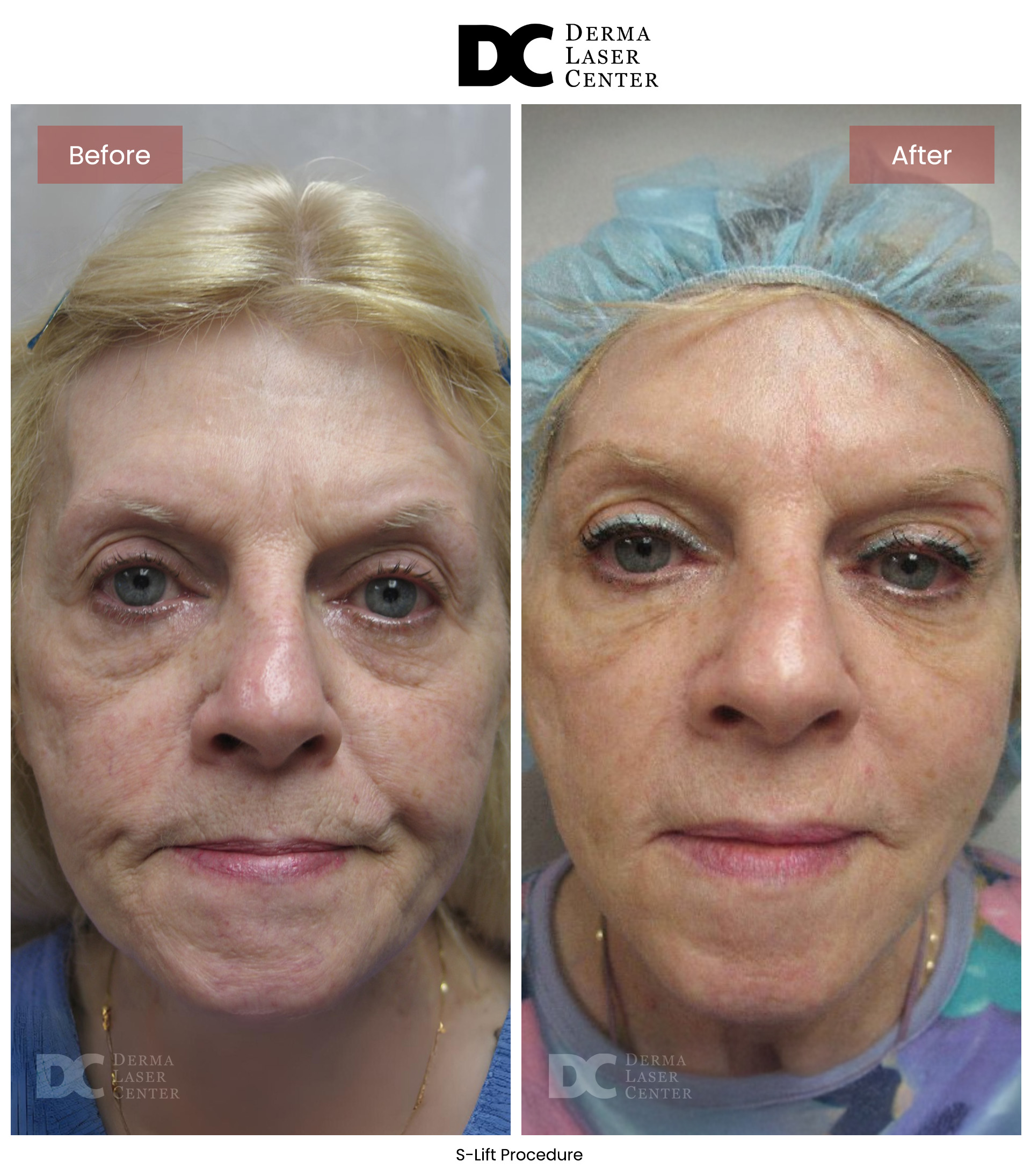 B&A S Lift Image 12 V1