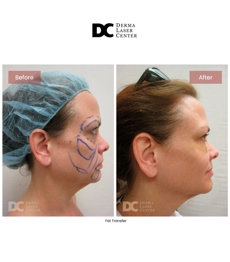 Fat transfer Image 53