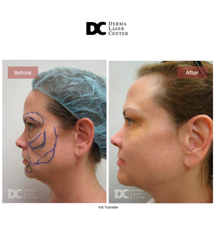 Fat transfer Image 54 V1