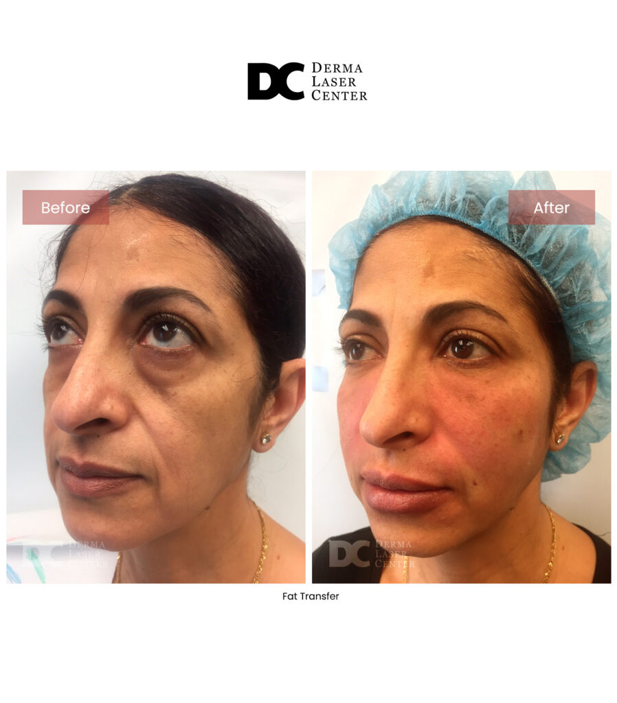 Fat transfer Image 57 V1