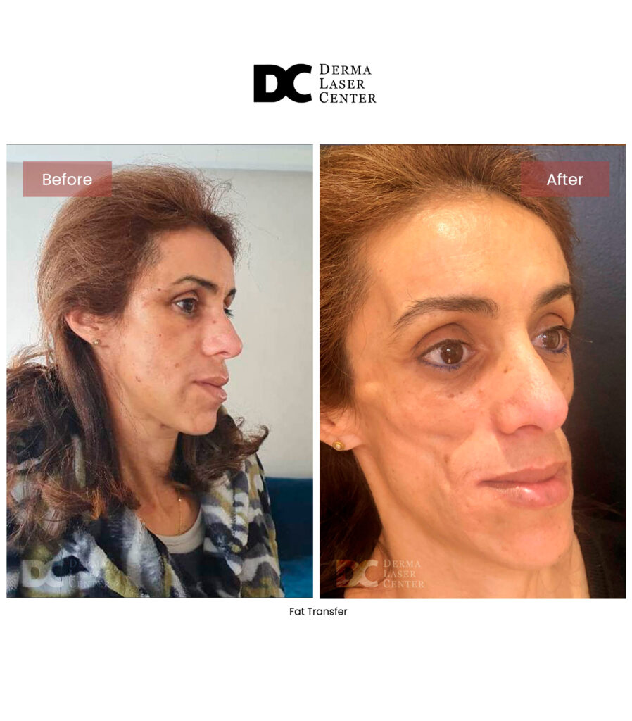 Fat transfer Image 61