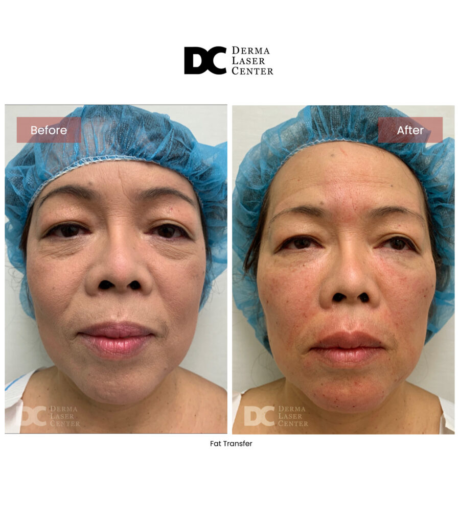Fat transfer Image 62