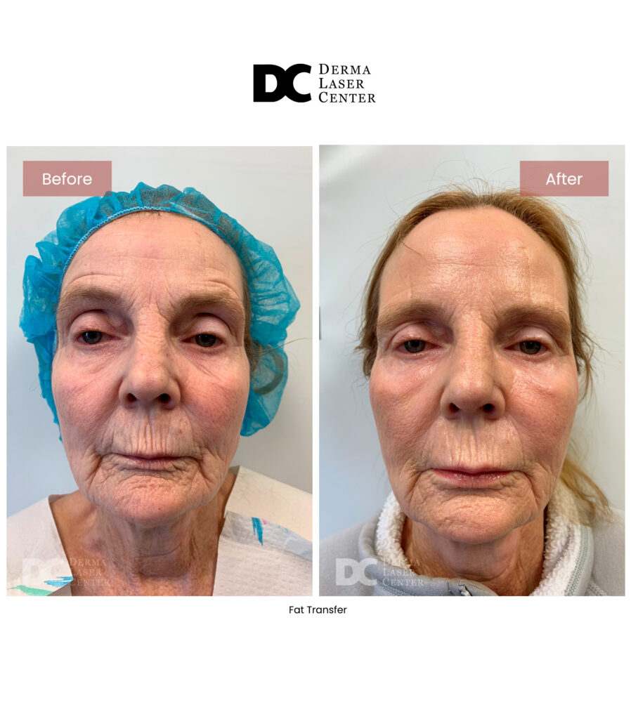 Fat transfer Image 63
